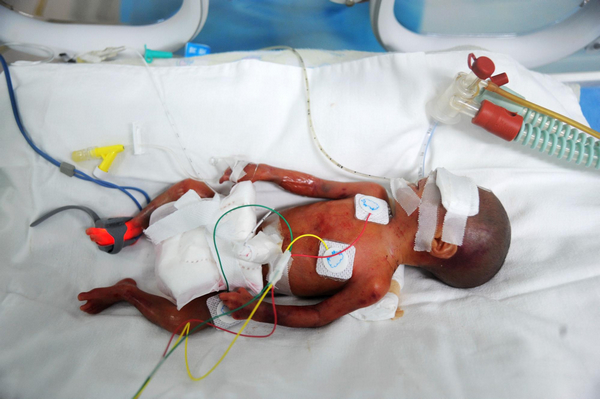 Tiny 500g baby born after 24 weeks in womb