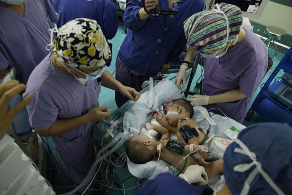 Medical team successfully separates conjoined twins