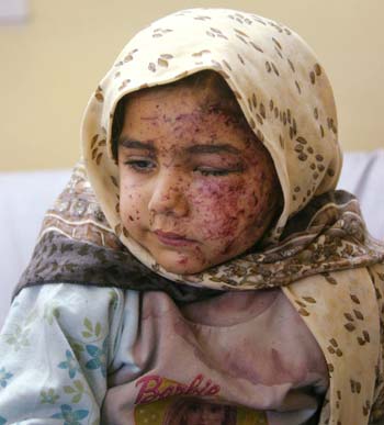 A young Iraqi girl in the main hospital recovers from wounds suffered in Sunday's car bomb attack in the holy city of Najaf December 20, 2004. Suicide car bombers struck Iraq's two main Shi'ite holy cities of Najaf and Kerbala on Sunday, killing at least 62 people and wounding nearly 130, in coordinated attacks six weeks before a historic election. [Reuters]