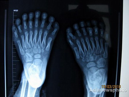 Boy with 31 fingers and toes ready for operation