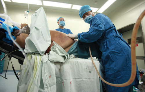 Overweight man gets rid of fat in surgery