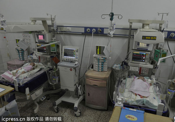 Conjoined babies separated in E China